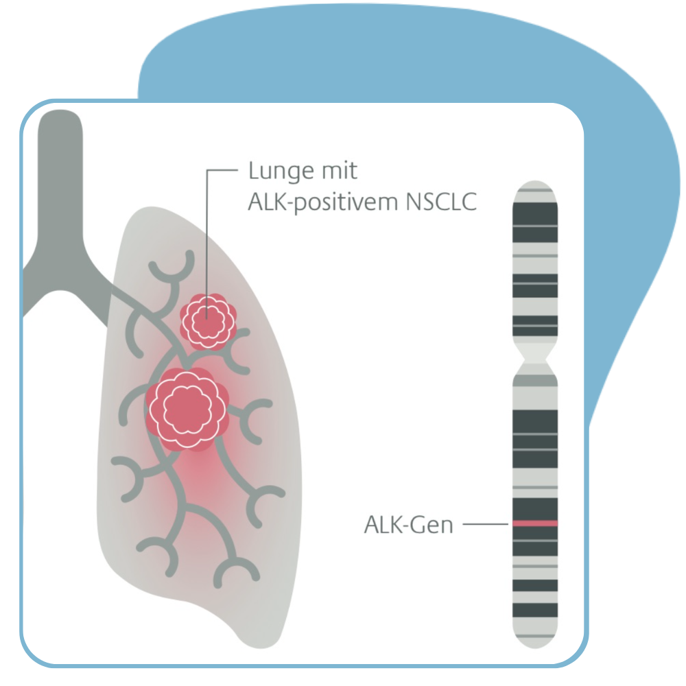 ALK-Translokation beim NSCLC